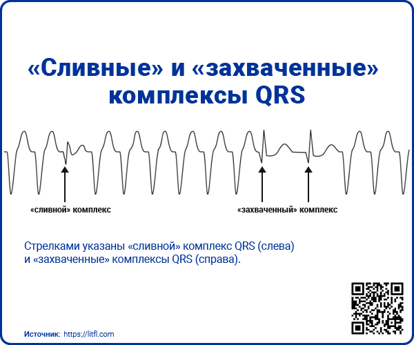 Сливные и захваченные комплексы QRS